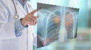 chpl news Ensartinib w leczeniu NSCLC z mutacją MET exon 14 - wyniki badania II fazy