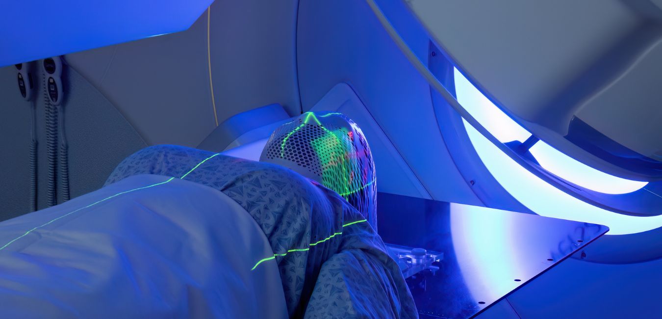 Poznaj przełom w radioterapii IMRT – skróć czas leczenia już dziś!